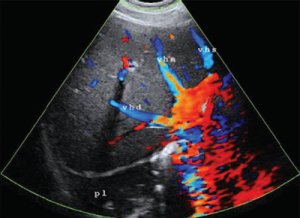 Dysgerminomul ovarului cauzează dezvoltarea, trăsăturile de diagnostic și tratamentul malign