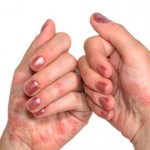 Дісгідротіческая екзема кистей рук причини, симптоми, лікування