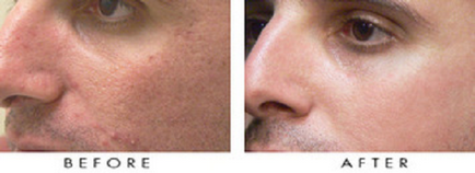 Efect masca facială din miere de la acnee