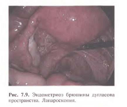 Endometrioza peritoneului pelvian ca proces patologic