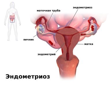 Hashártya endometriózis tünetei, okoz, a kezelés