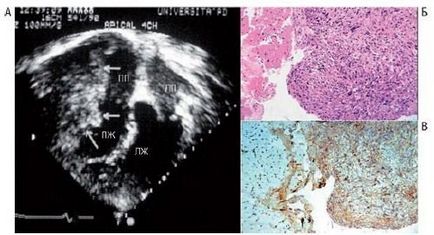 Endomiokardiális biopszia szívdaganatok