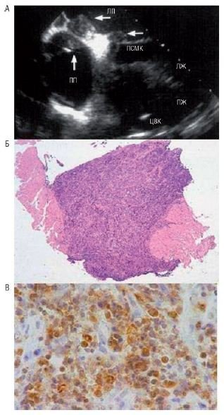 Ендоміокардіальна біопсія при пухлинах серця