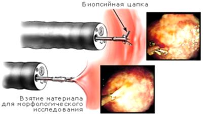 Endoscopie cu biopsie