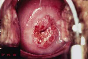 Ерозія шийки матки симптоми, лікування, причини, фото