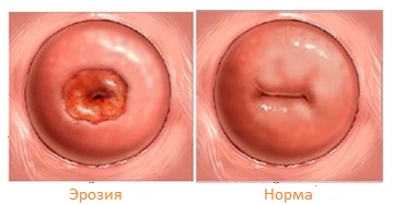 Eroziunea simptomelor cervixului, tratament, motive, fotografie