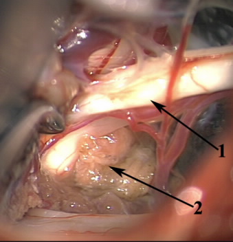 Spasmul gemifacial