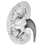 Rinichi spongios - cauze, simptome, diagnostic și tratament