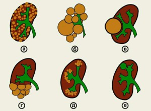 Губчаста нирка симптоми, причини і лікування