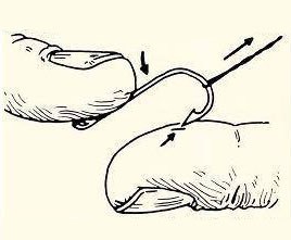 Як витягти рибальський гачок з тіла