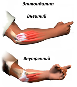Cum să tratați epicondilita externă și internă a articulației cotului cu unguente și remedii folclorice