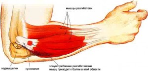 Cum să tratați epicondilita externă și internă a articulației cotului cu unguente și remedii folclorice