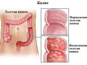 Cum se tratează inflamația tratamentului cecum-proctologie -if () - endif - catalogul de articole -