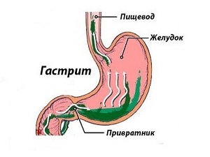 Як приймати де-нол при гастриті