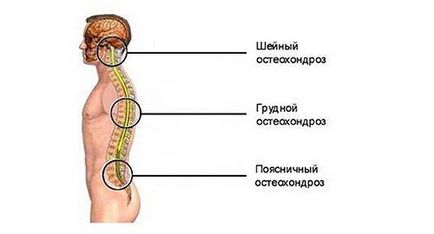 Cum să dormi cu osteochondrosis poziții corecte pentru somn