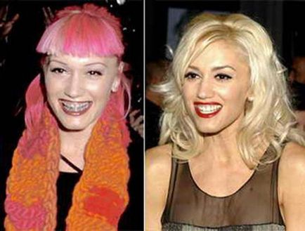 Як виглядали знамениті люди до і після брекетів