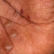 Cum arată eczema pe spatele fotografiei - 40 buc