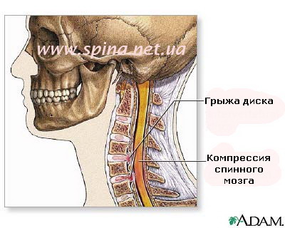 Cum se fixează vertebrele cervicale în 1 minut 1