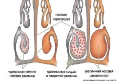 Picaturi cu rinita vasomotorie