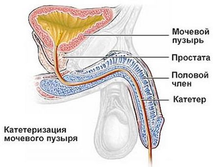 Katéterezése A húgyhólyag (a húgyhólyag) hólyagkatéterezés