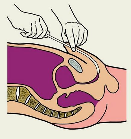 Cateterizarea vezicii urinare