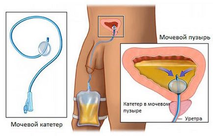 Cateterizarea vezicii urinare la bărbați - indicații, algoritm de realizare