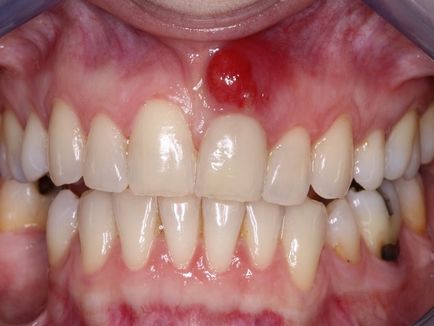 Cyst Gums Simptomele și cauzele de tratament la domiciliu Foto