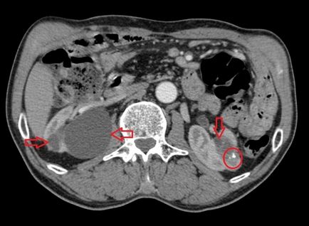 Kista pe rinichi - fotografie, video, descrierea patologiei