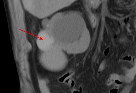 Kista pe rinichi - fotografie, video, descrierea patologiei