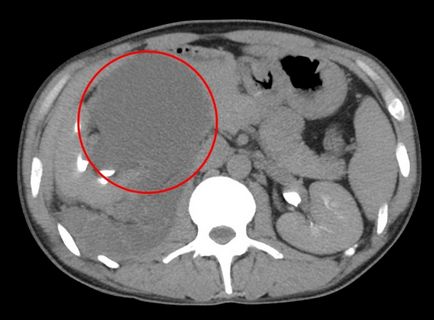 Кіста на нирці - фото, відео, опис патології