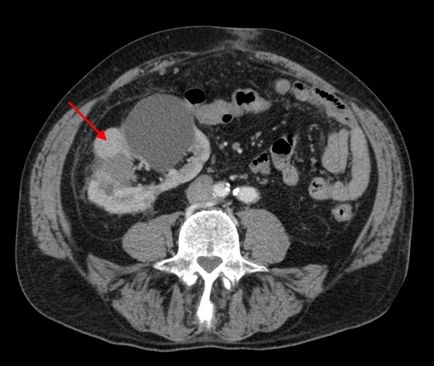 Кіста на нирці - фото, відео, опис патології