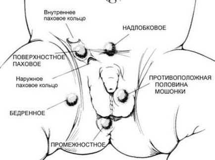 Când testiculele scad în patologia băieților și tratamentul lor