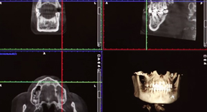 Tomografia computerizată pentru implantarea dinților