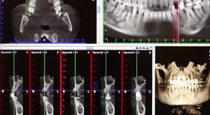 Tomografia computerizată pentru implantarea dinților