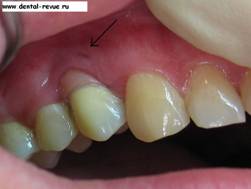 Tomografia computerizată cu implantare dentară