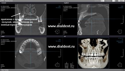 Комп'ютерна томографія при зубної імплантації
