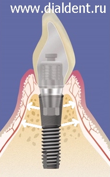 Tomografia computerizată cu implantare dentară
