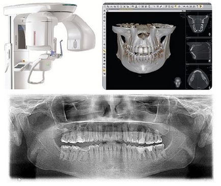 Tomografia computerizată a dinților (dentare) - 