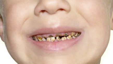 Коричневий наліт на зубах причини, як прибрати в домашніх умовах