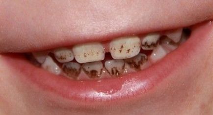 Cauzele de placă brună pe dinți, cum să curețe acasă