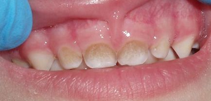Коричневий наліт на зубах причини, як прибрати в домашніх умовах