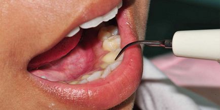 Коричневий наліт на зубах у дитини чому з'являється і як його прибрати