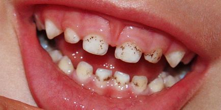 Placa brună de pe dinți a copilului de ce apare și cum să o eliminați