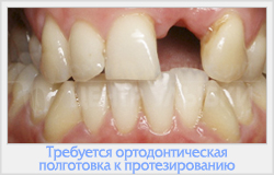 Корекція деформації щелеп і зубних дуг
