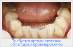 Corectarea deformării fălcilor și a arcadelor dentare