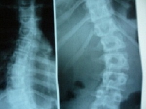 Javítás scoliosis (kifejezett) scoliosis korrekciós