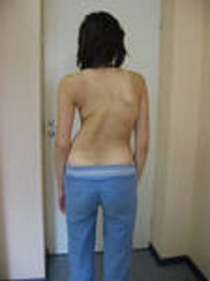 Javítás scoliosis (csigolya) scoliosis korrekciós