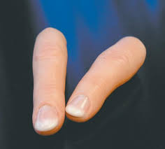 Proteze degete cosmetice - în Israel