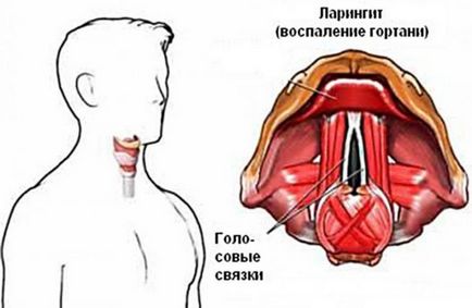 Ларингіт при вагітності причини, симптоми, лікування, можливі наслідки для жінки і дитини