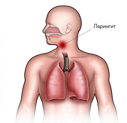 Ларингіт при вагітності причини, симптоми, лікування, можливі наслідки для жінки і дитини